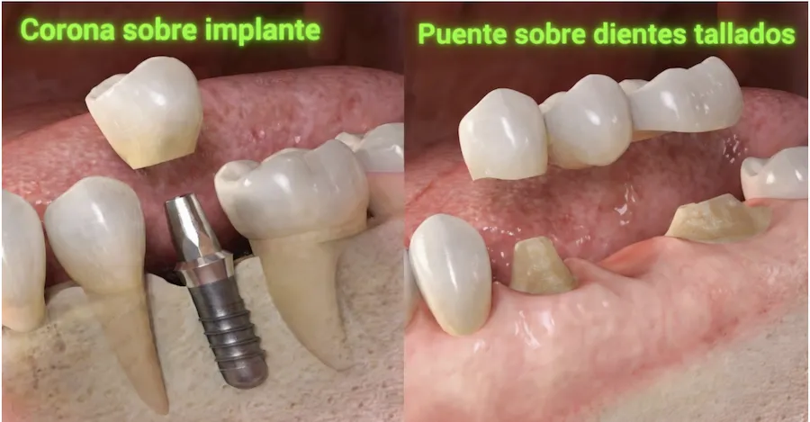 Comparación visual entre corona sobre implante dental y puente sobre dientes tallados — Dental One El Salvador, San Salvador