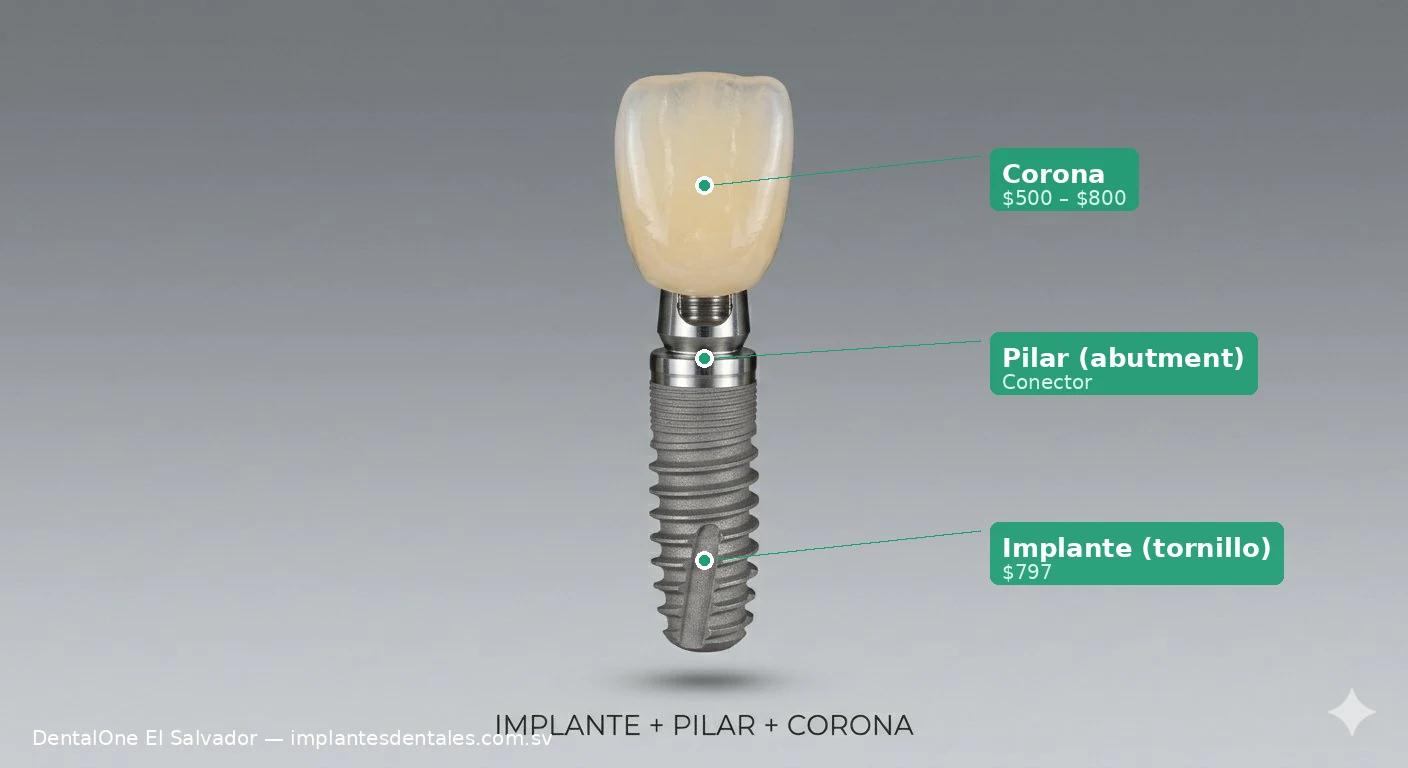 Las 3 partes de un implante dental: corona ($500–$800), pilar abutment y tornillo de titanio ($797) — Dental One El Salvador